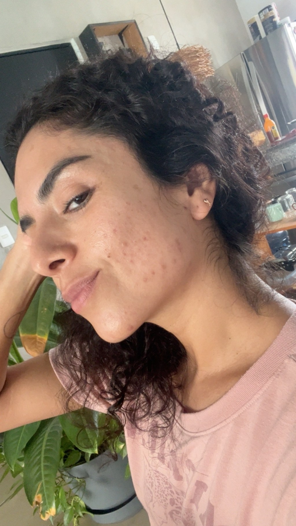 Mayo-2025 – Acné (late&nbsp;post)